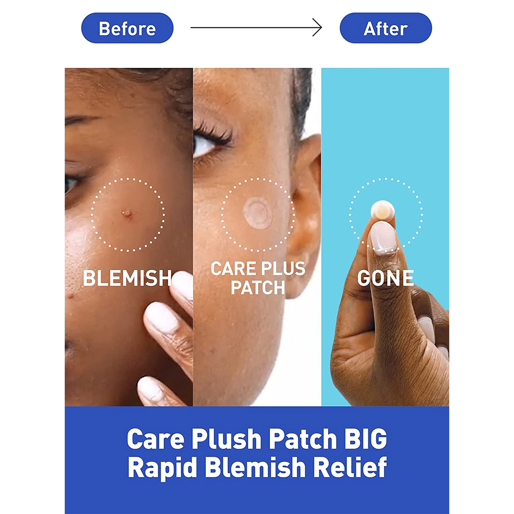 OLIVE YOUNG 痘痘遮瑕贴 PLUS