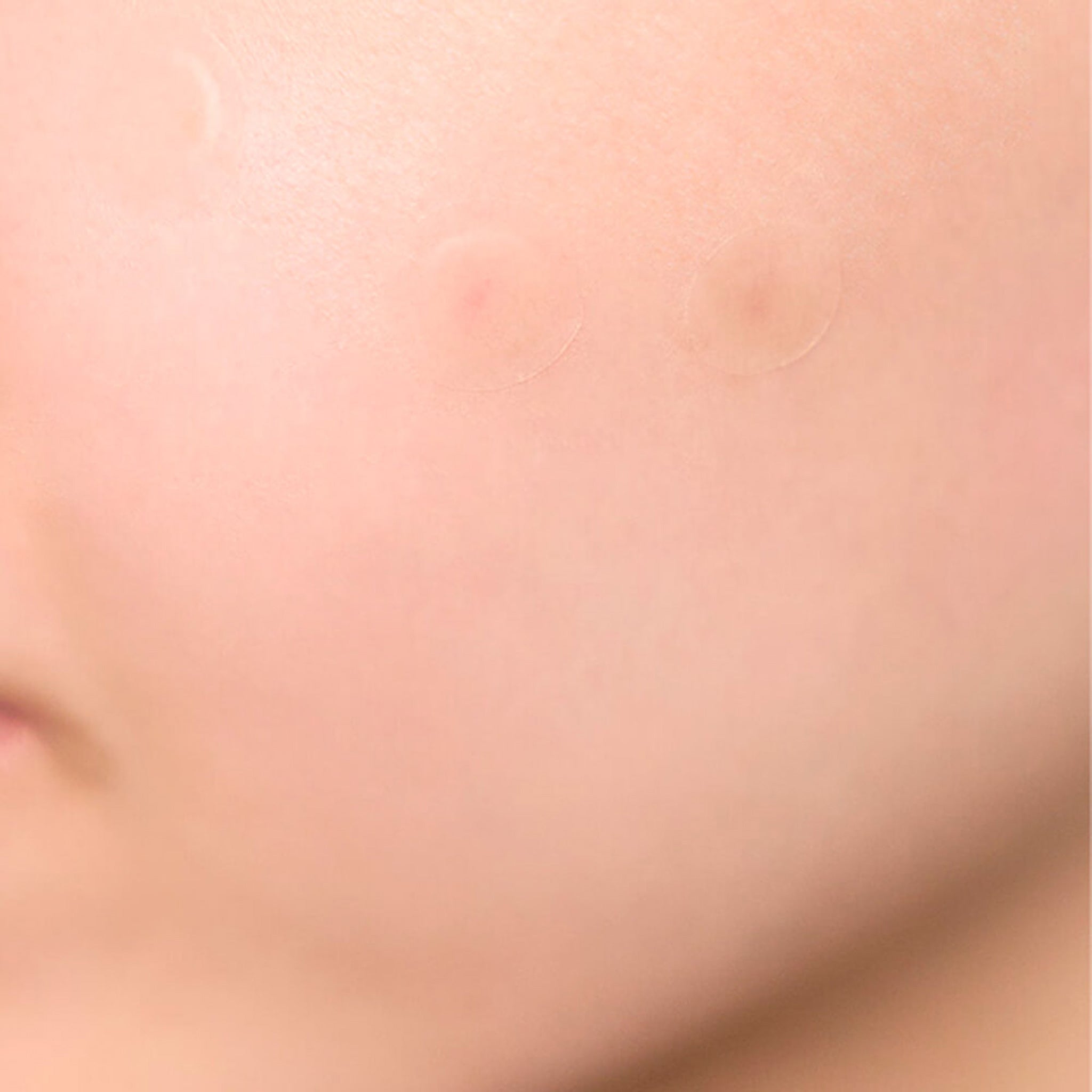 SKIN1004 理肤天使 茶树隐形痘痘贴 22片